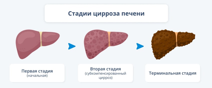 Природные средства защиты нашей печени